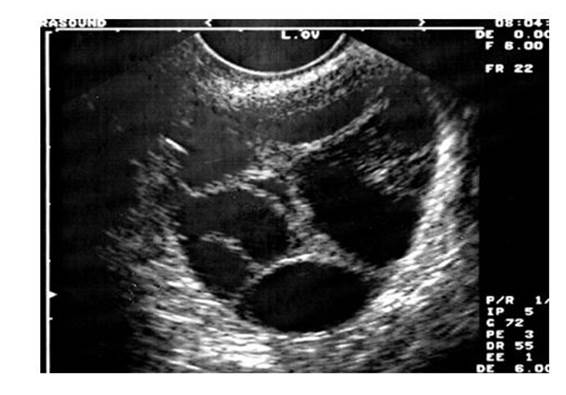 ultrasound of ovary newcastle egg donation